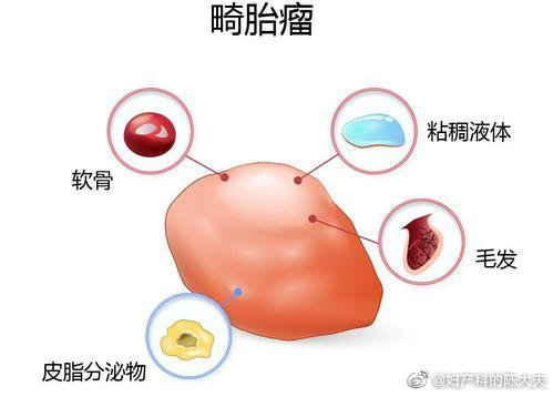 1岁女童肚中取出柚子大小畸胎瘤是怎么回事 畸胎瘤是怎么回事